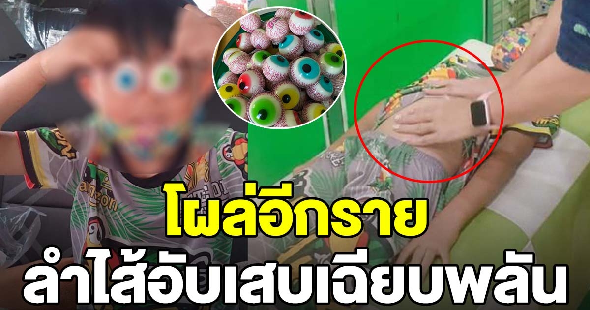 โผล่อีกราย เด็กกินเยลลี่ลูกตา ลำไส้อักเสบเฉียบพลัน