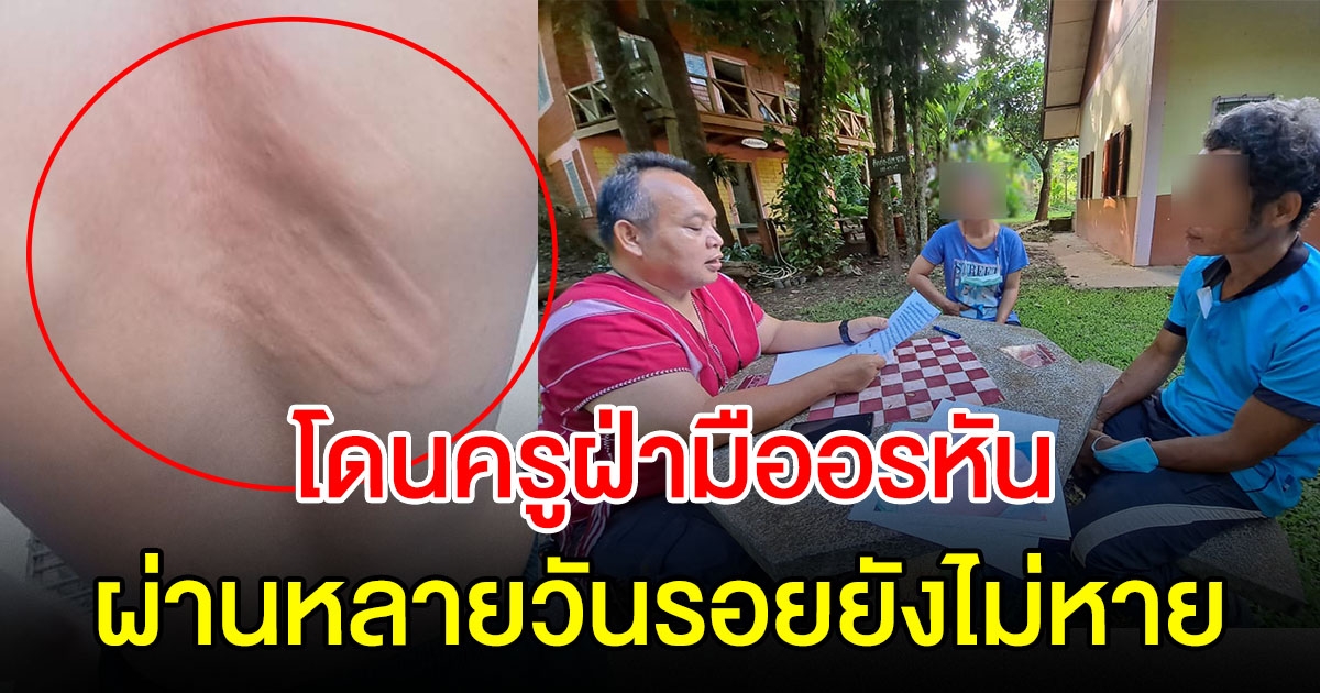 ครูฝ่ามืออรหัน ฟาดหลังจนเป็นรอย ผู้ปกครองเตรียมแจ้งความ