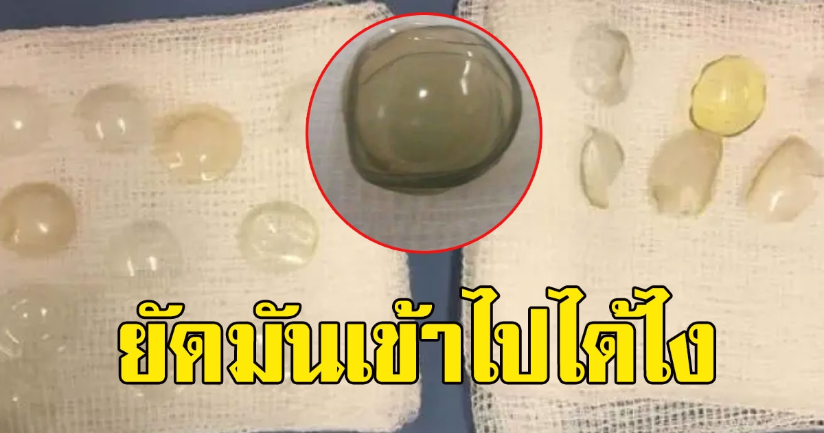 รู้สึกเจ็บตาและมองไม่ชัด ทนไม่ไหวต้องไปหาหมอ ตรวจเจอเต็มๆ 35ปีที่ผ่านมา