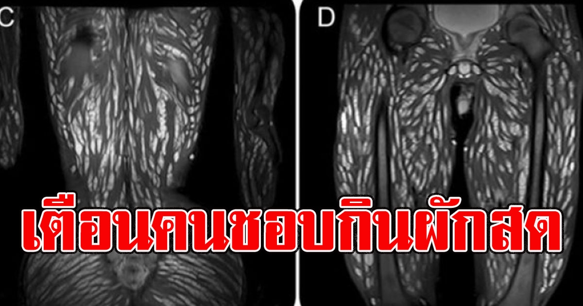 หมอเตือนเอง คนชอบกินผักสด ซีสต์พยาธิตืดหมู เต็มตัวคนไข้วัย 18 ปี