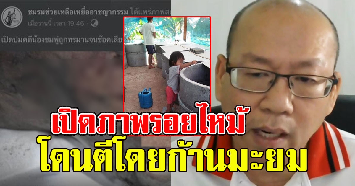 อัจฉริยะ เผยภาพรอยไหม้คาดน้องชมพู่ โดนตีโดยก้านมะยม