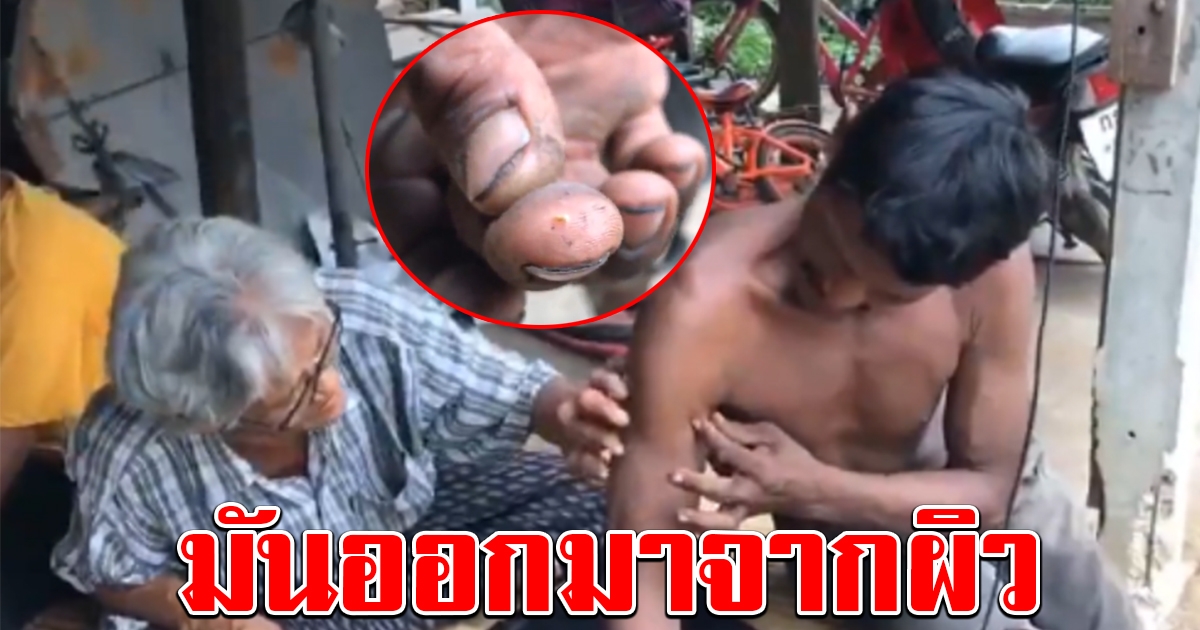 ยาย หลาน ผวา ร่างกายมีตัวประหลาด ชอนไชออกมาจากผิว