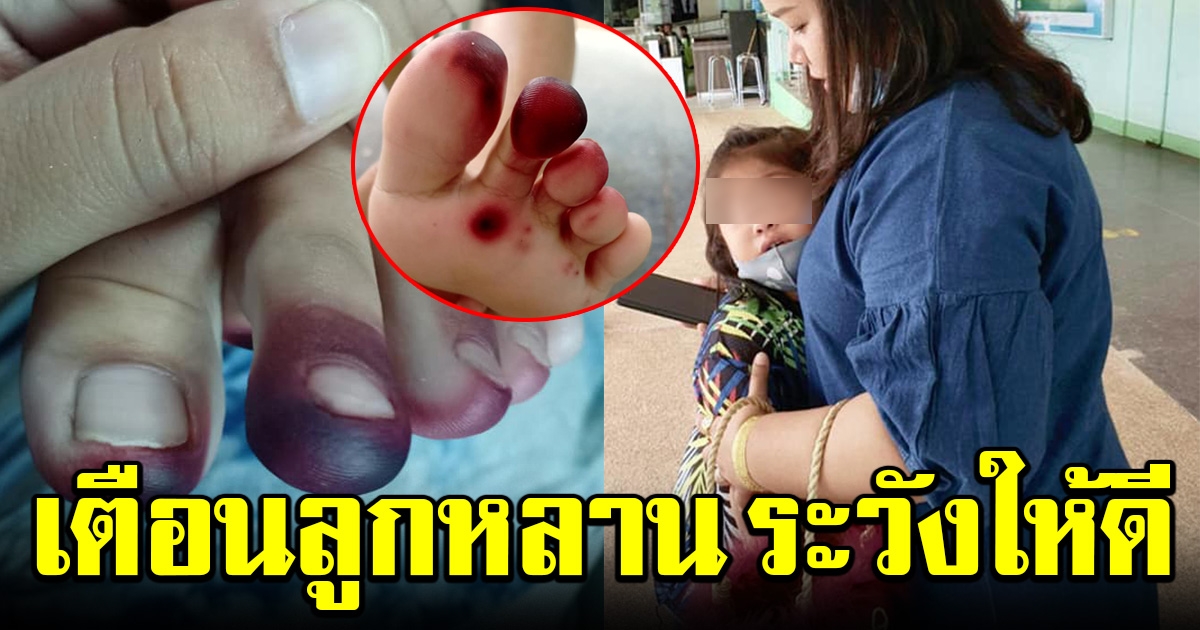 อุทาหรณ์ หนูน้อยร่ำไห้ เท้าเป็นรอยไหม้ดำ แม่เอะใจ ส่องดูในรองเท้าเจอเต็มๆ