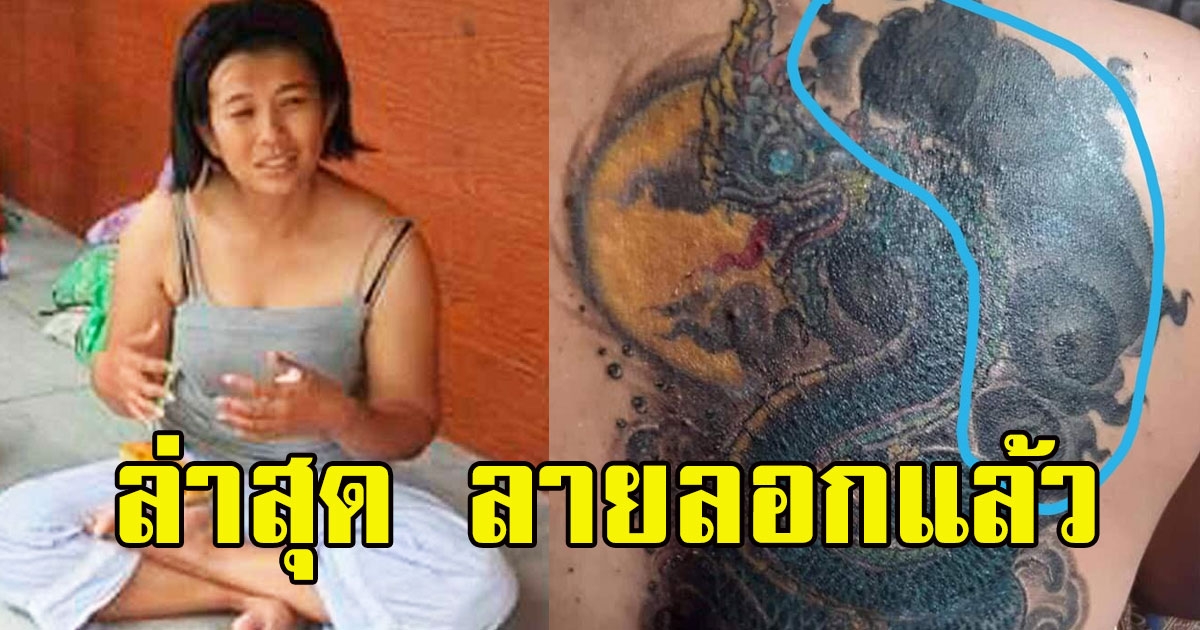 ดราม่าไม่จบ สาวสักพญานาค เผยอาการล่าสุด ลายลอกแล้ว