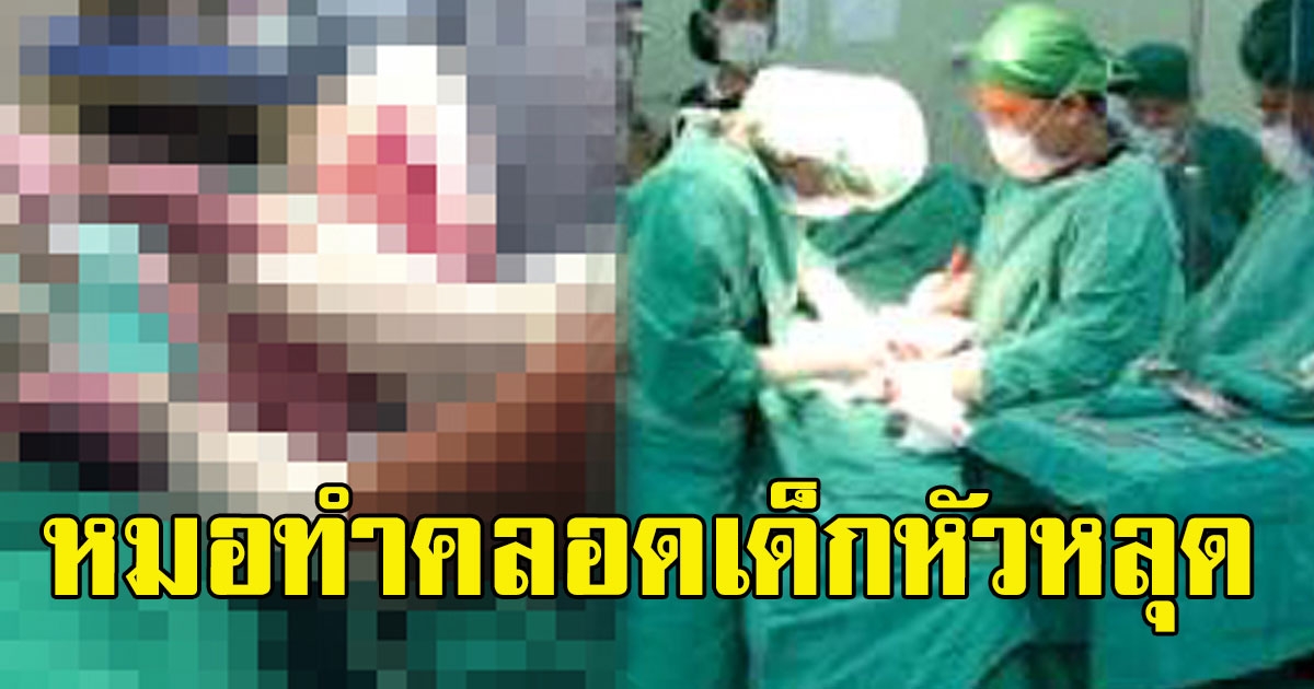 หมอทำคลอดเด็กหัวหลุดกลางคัน ต้องผ่านำตัวที่เหลือออกจากท้องแม่