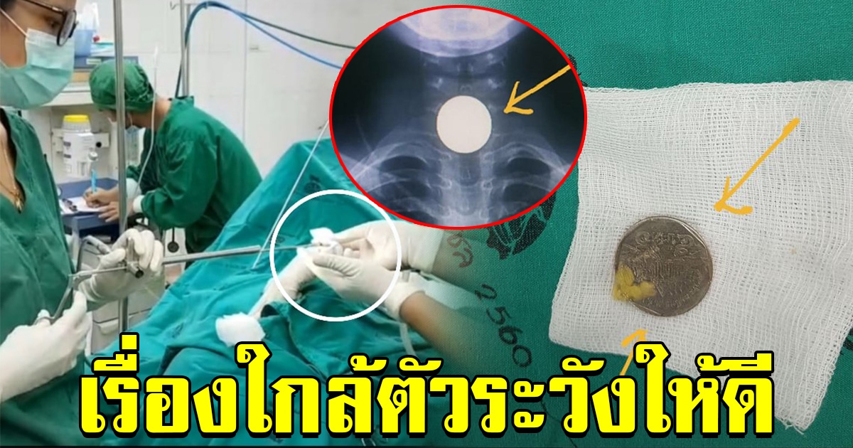 หมอโพสต์เตือน หลังต้องผ่าเอาเหรียญ 5 ออกจากคอเด็ก 6 ขวบ