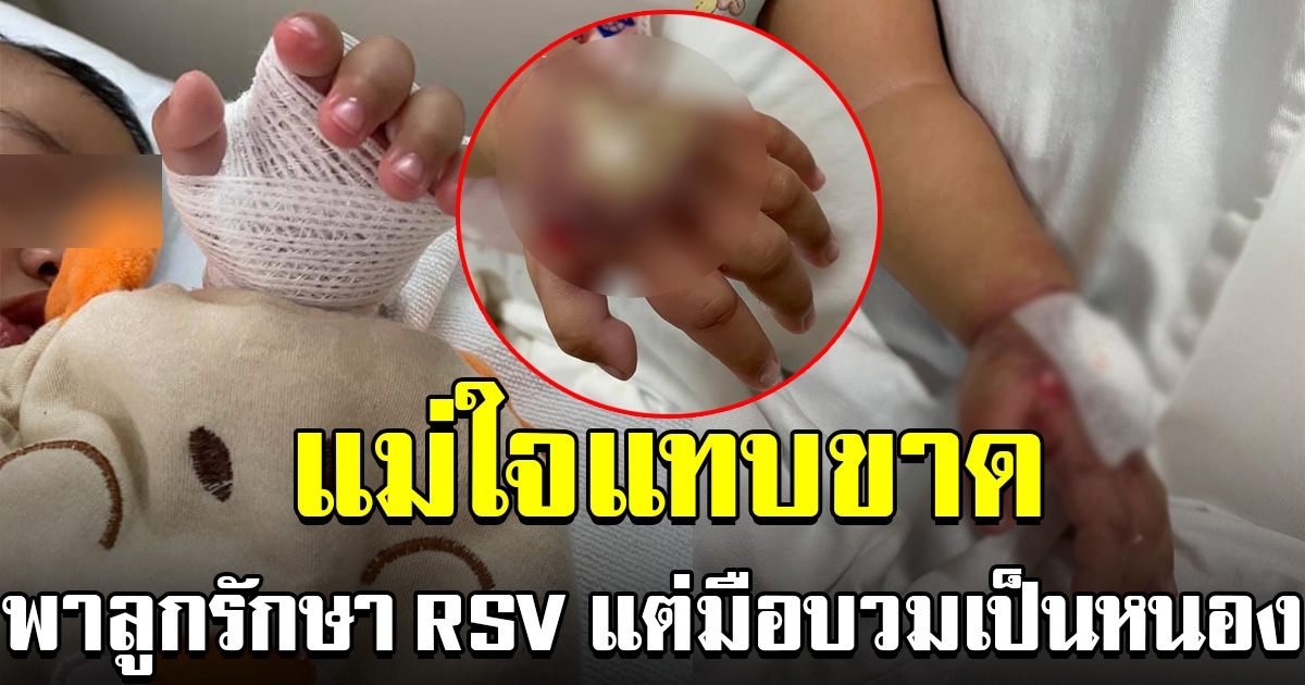 เคราะห์ซ้ำกรรมซัด แม่ใจแทบขาด พาลูกรักษา RSV แต่มือบวมเป็นหนอง
