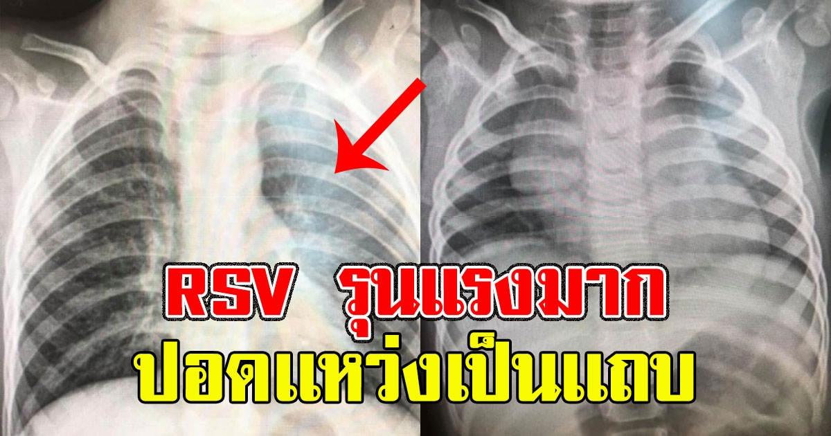 ด่วน เปิดภาพปอดจากผู้ป่วย ไวรัส RSV ปอดเเหว่งเป็นเเถบ
