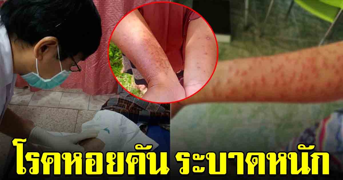 หมอเตือนระวังให้ดี โรคหอยคัน ระบาดหนัก คนแห่เข้า รพ.