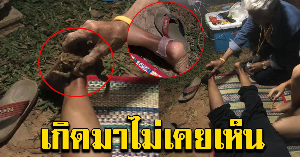 หนุ่มสุดงง น้าโดนตะขาบกัด แต่คนทำแผล เอาคางคกมาถู