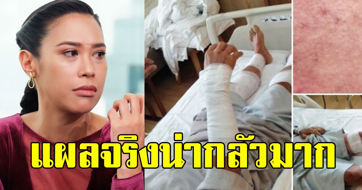 ทราย เผยภาพผู้ชุมนุม แผลทั้งตัว หลังโดนสารเคมีจากรถฉีดน้ำ