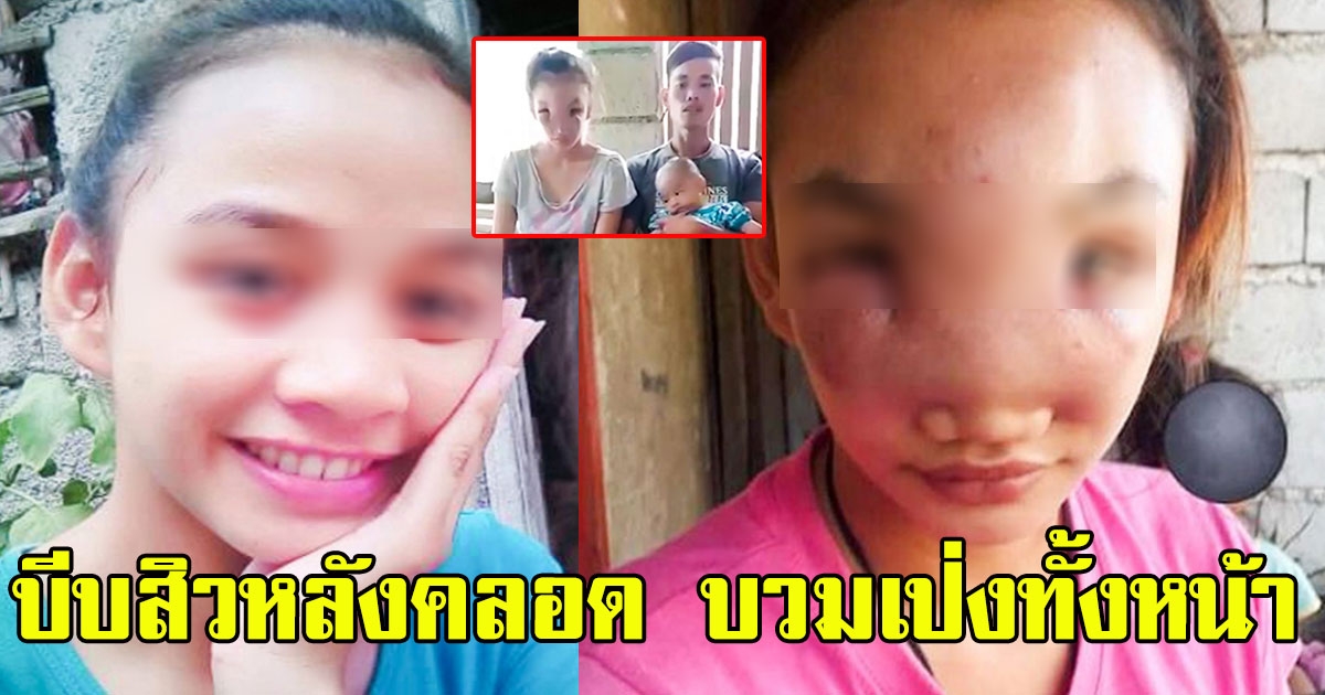 สุดเจ็บปวด สาว 17 เพิ่งคลอด บีบสิวตรงจมูก บวมเป่งทั้งหน้าจนมองไม่เห็น